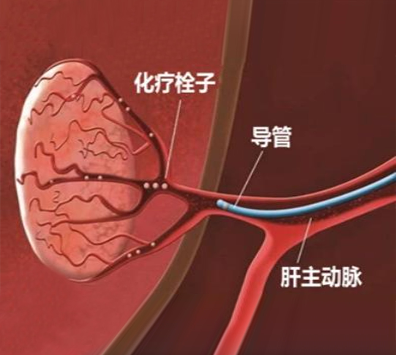 栓塞微球
