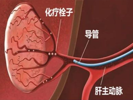 栓塞微球