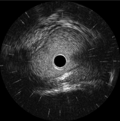 血管内超声成像（IVUS）完成临床前动物实验研究