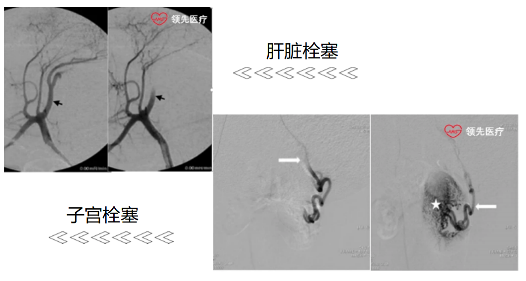 栓塞微球